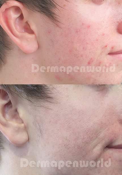 Dermapen. Zabieg. Efekty