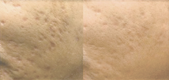 Dermapen. Efety. Zabieg